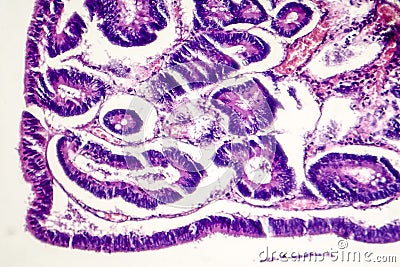 Intestinal polypoid adenoma Stock Photo