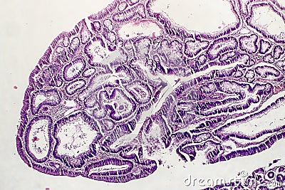 Intestinal polypoid adenoma Stock Photo