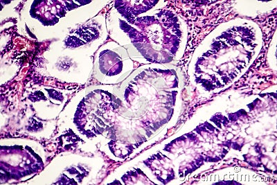 Intestinal polypoid adenoma Stock Photo