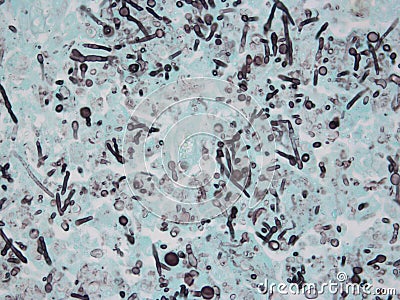 Intestine with Aspergillus Fungus (Black) Stock Photo