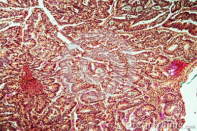 Intestine with villi and goblet cells Carcinoma tissue Stock Photo