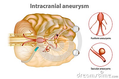 Intracranial aneurysm or brain aneurysm. Vector Illustration