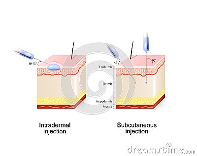 Intradermal and Subcutaneous injection Vector Illustration