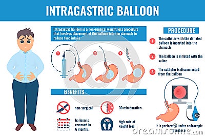 Intragastric balloon weight loss procedure medical infographic Vector Illustration