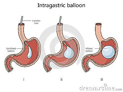 intragastric stomach balloon structure medical Vector Illustration