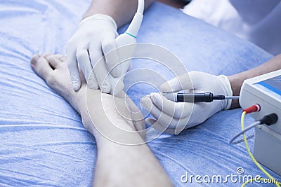 Intratissue percutaneous electrolysis Stock Photo