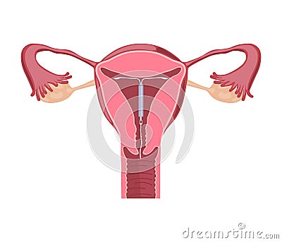 Intrauterine Device. Contraceptives Method Vector Illustration