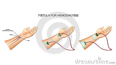 Intravenous catheter, hemodialysis and fistula Vector Illustration