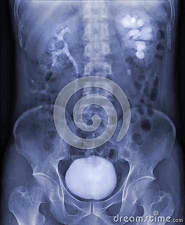 Intravenous pyelogram or I.V.P is an X-ray exam of urinary tract after injection contrast media agent showing full bladder Stock Photo
