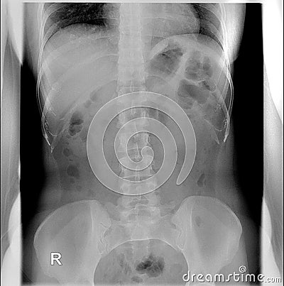Intravenous pyelogram. Supine position. Intestinal gas partially overlying renal shadows... Stock Photo