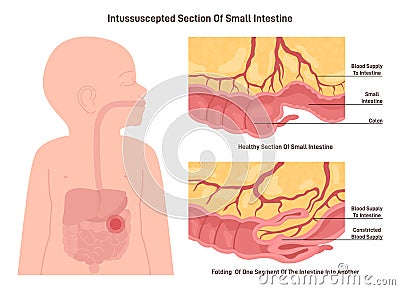 Intussusception. Congenital condition in which part of the intestine Vector Illustration