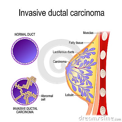 Invasive ductal carcinoma Vector Illustration