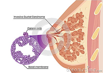 Invasive ductal carcinoma sctructure and pathology Vector Illustration