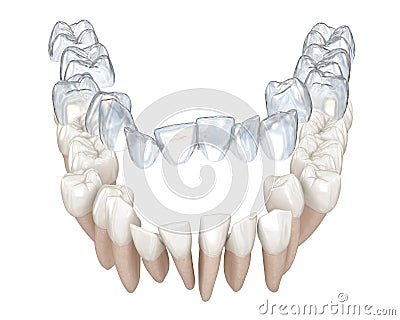 Invisalign braces or invisible retainer make bite correction. Medically accurate 3D animation Stock Photo