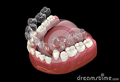 Invisalign braces or invisible retainer make bite correction. Medically accurate 3D illustration Cartoon Illustration