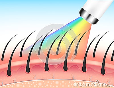 IPL light (Intense Pulsed Light) and Laser hair removal on skin layer leg. Unwanted out make skin smooth. Vector Illustration