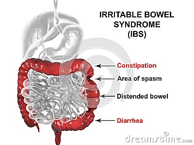 Irritable bowel syndrome IBS medical concept Cartoon Illustration