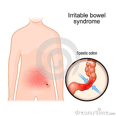 Irritable bowel syndrome. IBS Vector Illustration