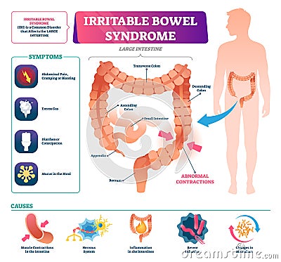 Irritable bowel syndrome vector illustration. Labeled medical disease graph Vector Illustration