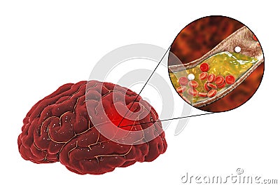 Brain stroke concept Cartoon Illustration