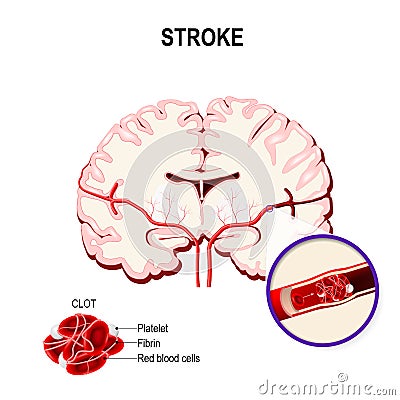 Ischemic stroke in the cerebral artery and thrombus. Vector Illustration