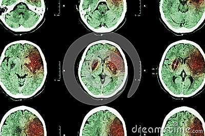 Ischemic stroke : ( CT of brain show cerebral infarction at left frontal - temporal - parietal lobe ) ( nervous system background Stock Photo