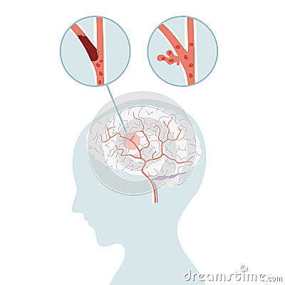 Ischemic stroke and hemorrhagic stroke, stroke brain concept in flat vector Vector Illustration