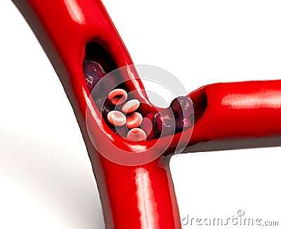 Ischemic stroke. Thrombus blood clot in the veins artery occlusion. Brain Stock Photo