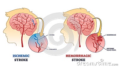 Ischemic vs hemorrhagic head stroke anatomical comparison outline diagram Vector Illustration