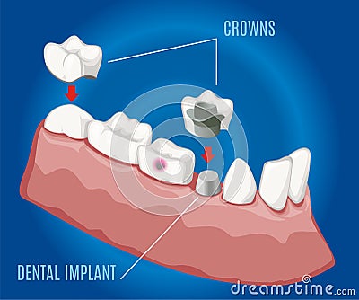 Isometric Professional Prosthetic Stomatology Template Vector Illustration