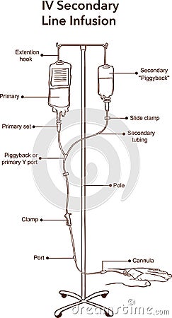 IV Secondary Line Infusion vector illustration Vector Illustration