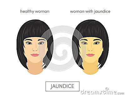 Jaundice concept Stock Photo