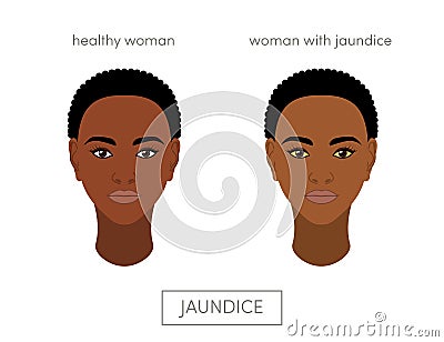 Jaundice concept Stock Photo