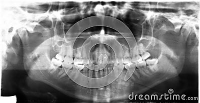 Dental Xray (x-ray) Stock Photo