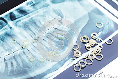 Jaw xray and orthodontic latex rings for braces Stock Photo