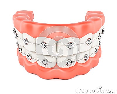 Jaws with dental braces Stock Photo