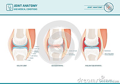 Joint anatomy, osteoarthritis and rheumatoid arthritis infographic Vector Illustration