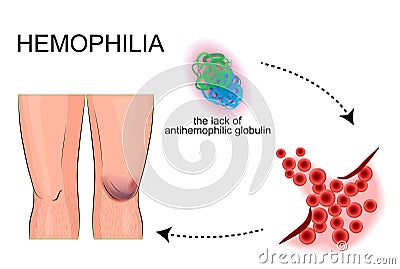 The joints hemophilia. bleeding. injury. Vector Illustration