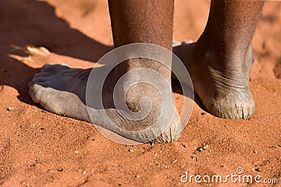 Woman with cracked heels in the sand Stock Photo