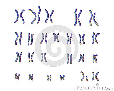 Karyotype of Cri du chat, or cat's cry, syndrome, also known as 5p- syndrome Cartoon Illustration