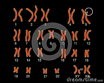 Karyotype Of Cri Du Chat, Or Cat's Cry, Syndrome, Also Known As 5p ...