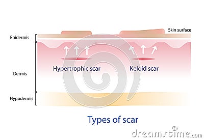 Keloid scar and hypertrophic scar on skin surface. Vector Illustration