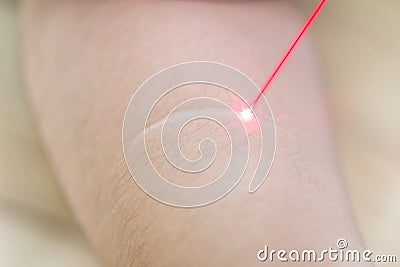 Keloid or scar with laser remove skin care medical Stock Photo