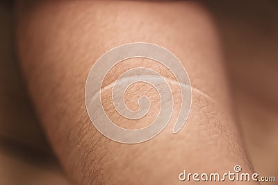Keloid. ugly women arm skin scar from knife Stock Photo