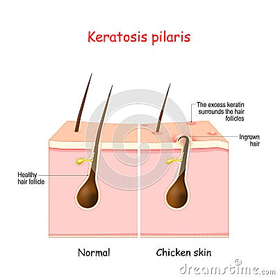 Keratosis pilaris. lichen pilaris and hair follicle Vector Illustration