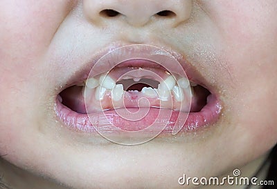 A kid losing baby teeth Stock Photo
