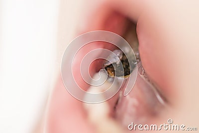 Kid patient open mouth showing cavities teeth decay. Pus in the mouth of a boy with tooth decay Stock Photo