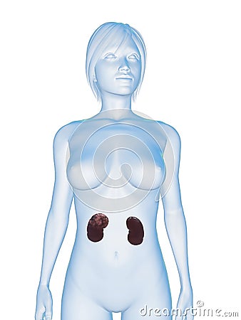 Kidney cancer Cartoon Illustration