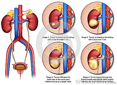 Kidney cancer 3d medical vector illustration with description isolated on white background with urinary system Vector Illustration