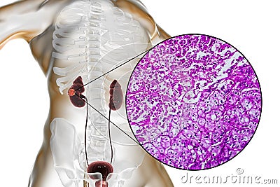 Kidney cancer, illustration and light micrograph Cartoon Illustration